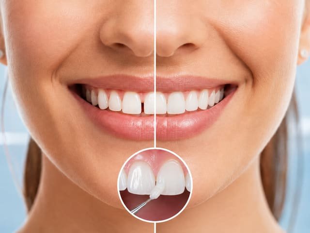 Options for closing gaps between teeth without braces