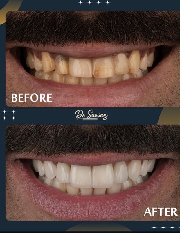 Smile transformation by Dr. Sawsan Awartani — before and after