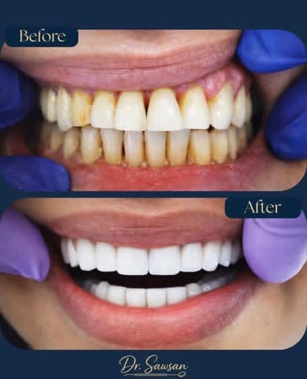 Smile transformation by Dr. Sawsan Awartani — before and after