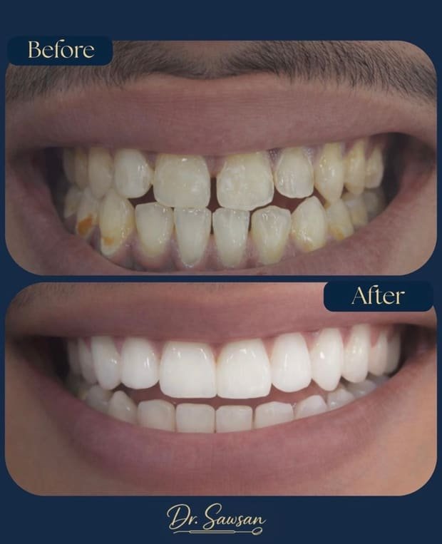 Smile transformation by Dr. Sawsan Awartani — before and after