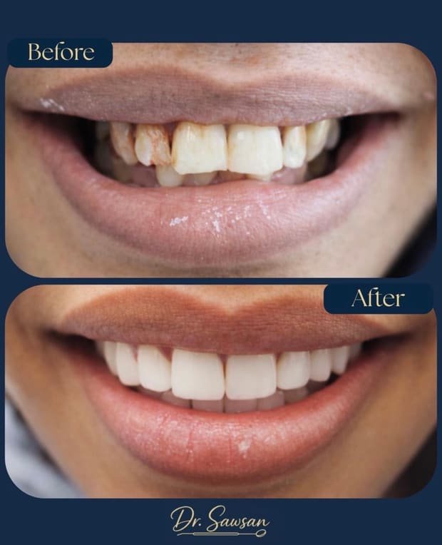 Smile transformation by Dr. Sawsan Awartani — before and after