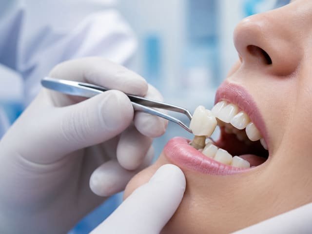 Zirconia crown restoration with Dr. Sawsan Awartani in Dubai
